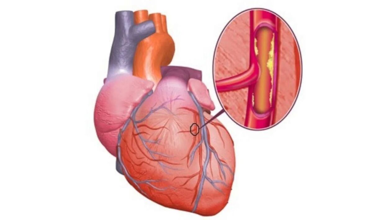 Heart problems due to high blood pressure