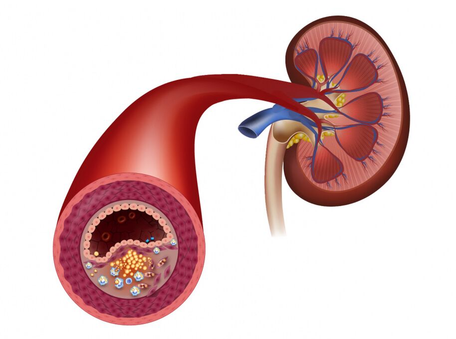 Reduction of blood flow due to atherosclerosis